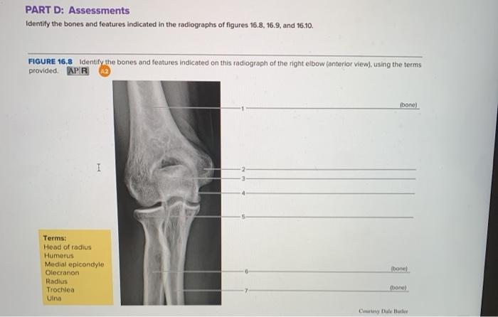 Bones indicated radiograph radiographs